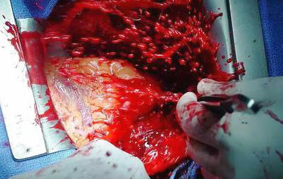 美国治疗主动脉夹层,倪海厦治疗主动脉夹层