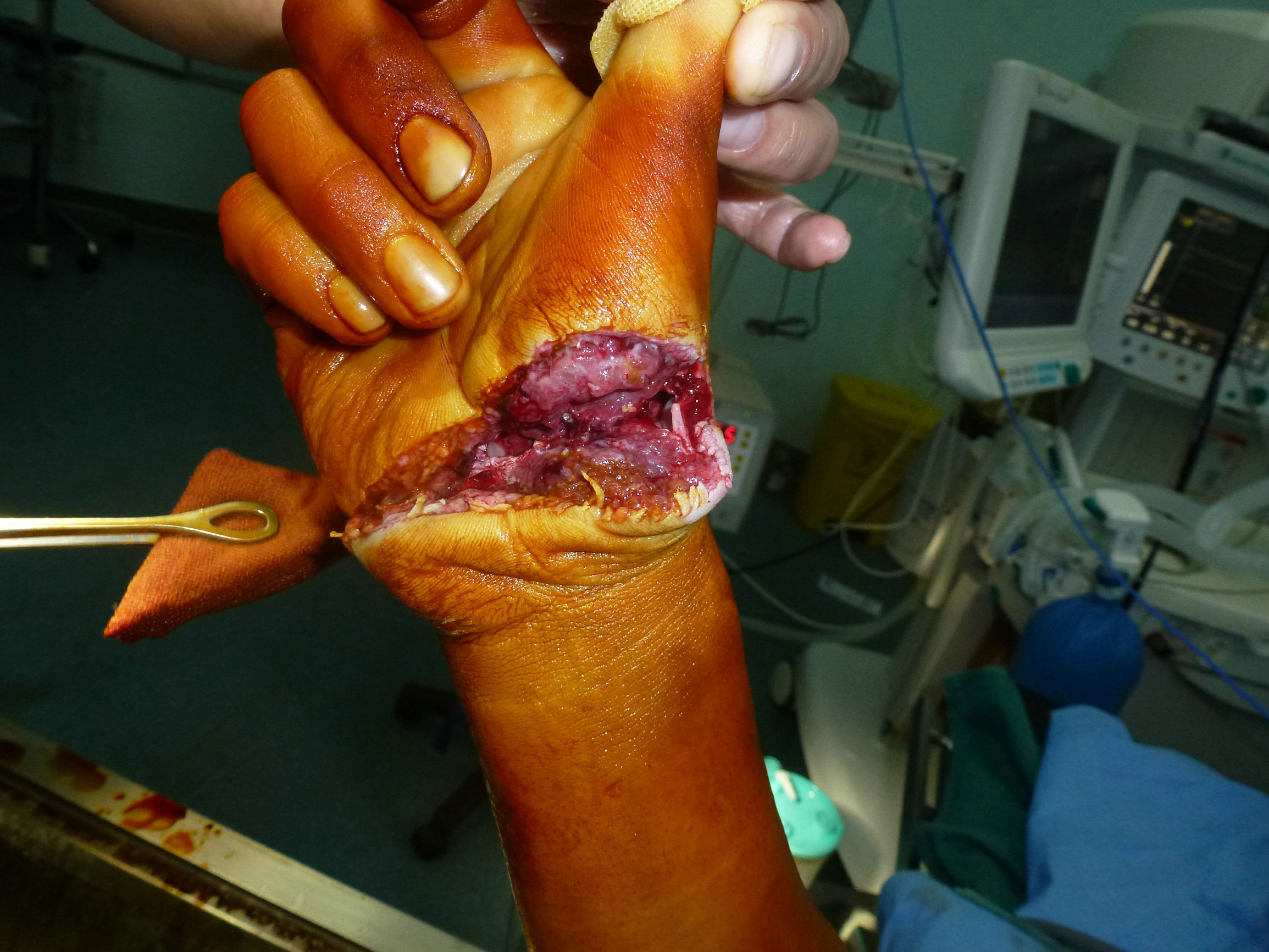 306医院骨科专家谈电锯伤手的处理