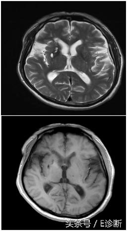 E诊断：脑梗塞影像图解