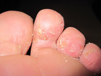 治疗脚出汗脚气的小偏方有哪些,脚气小偏方脚丫裂口了痒的厉害