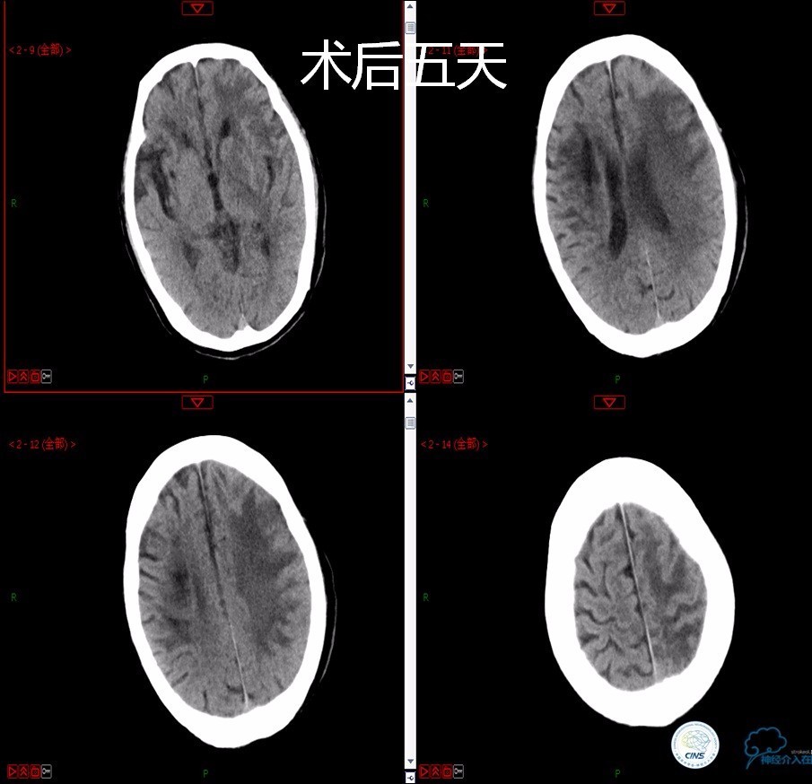 颈动脉次全闭塞,颈动脉次全闭塞中医疗法