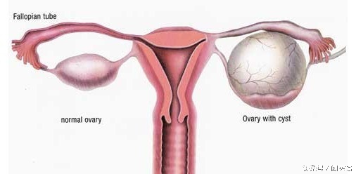 卵巢囊肿11厘米要怎么手术,卵巢囊肿16厘米手术方式