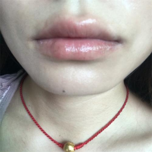 为什么剥脱性唇炎那么难好,剥脱性唇炎是细菌还是病毒