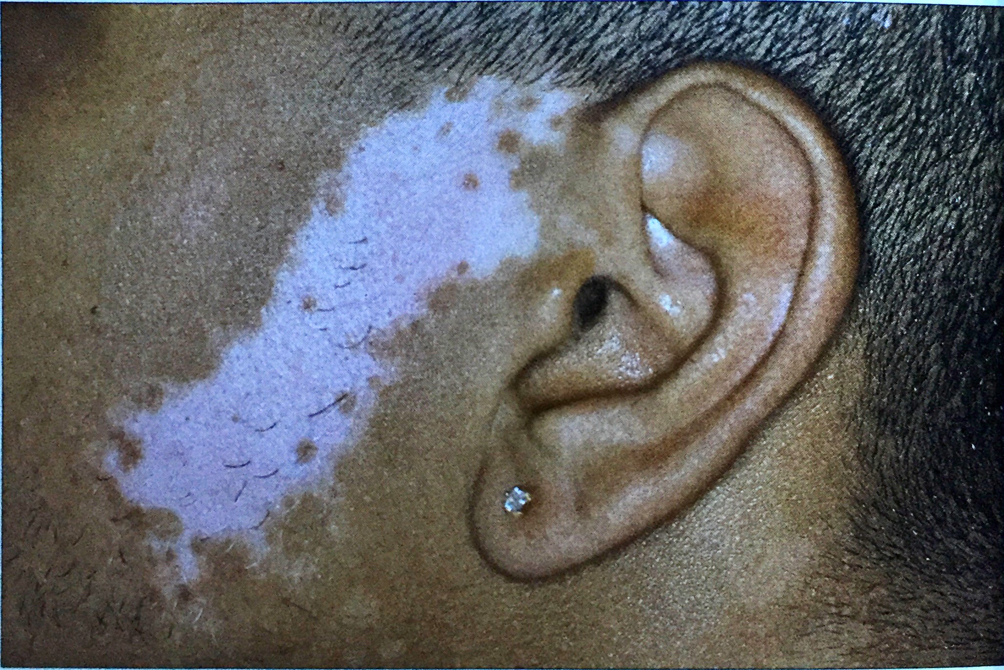 患上白癜风怎么办,治疗白癜风遇到瓶颈期怎么办