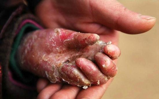 8岁男孩身患怪病,男孩患怪病的真实案例