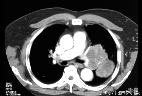肺微浸润性腺癌能做消融手术吗,肺射频消融手术真实经历