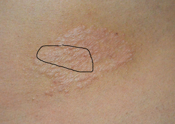 这些癌前病变千万别忽略,这些症状你千万别再忽略了