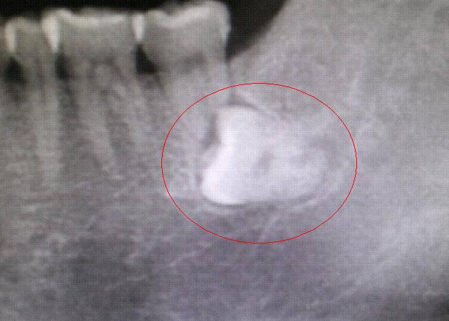 拔牙到底有多惨,拔牙都有什么有趣的经历