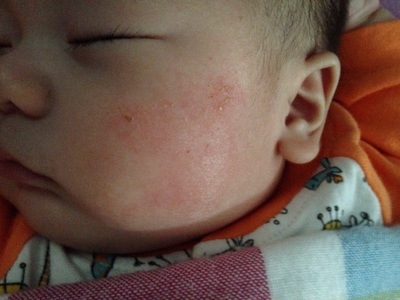 婴儿湿疹要及时不然危害是你想象不到的