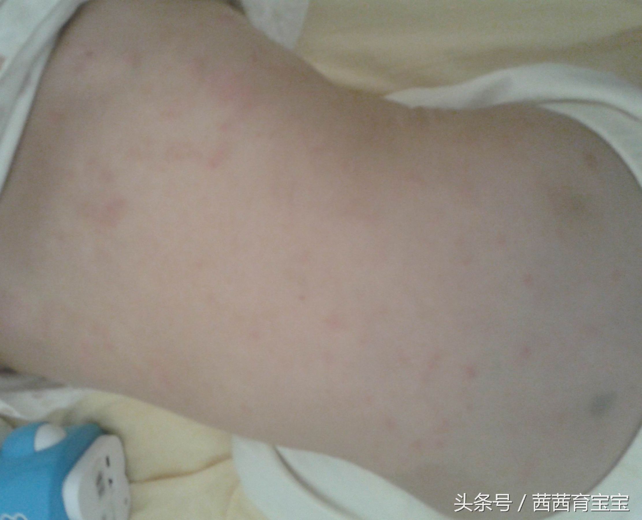 宝宝长湿疹是因为热吗,宝宝屁屁长湿疹怎么办