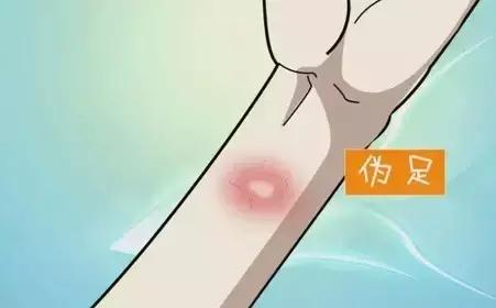 输液需要皮试的有哪些,输液做皮试是什么意思