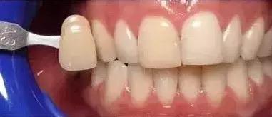 关于牙齿你需要知道的三件事,关于美白那些你不得不知道的事儿