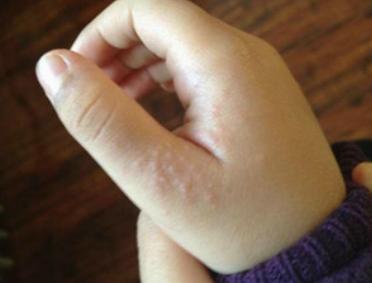 水泡湿疹怎么治疗?老中医妙招治皮肤病湿疹。