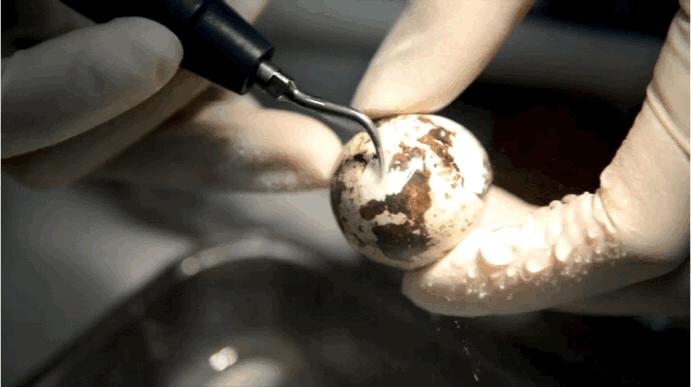 牙医科普洗牙,鹌鹑蛋洗牙后遗症