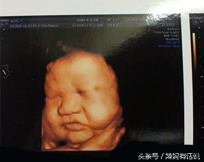 34周引产有生命危险吗,34周引产后的胎儿怎么处理