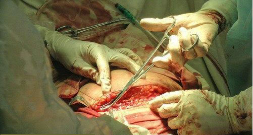 听说剖腹产更轻松？看看过来人怎么说！