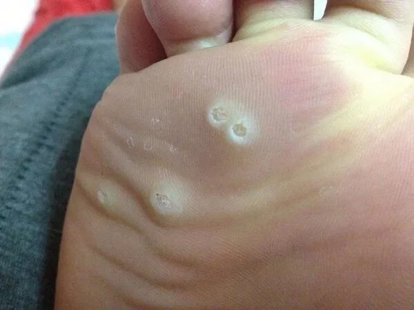 鸡眼病因,鸡眼发病原因与中医治疗