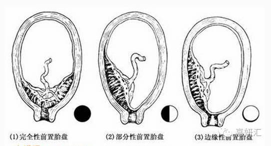 关于孕妇胎盘,胎盘的十大知识