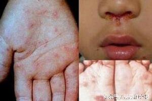 男童发烧38度一直降不下来怎么办,男童高烧39度吃药不退