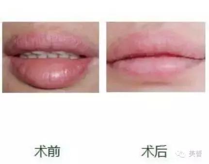 唇唇欲动攻略,唇部拯救你的唇形