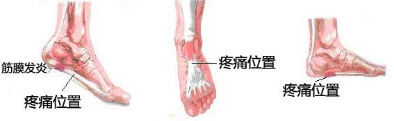 跑步足底筋膜炎后期如何康复训练,足底筋膜炎穿什么鞋跑步