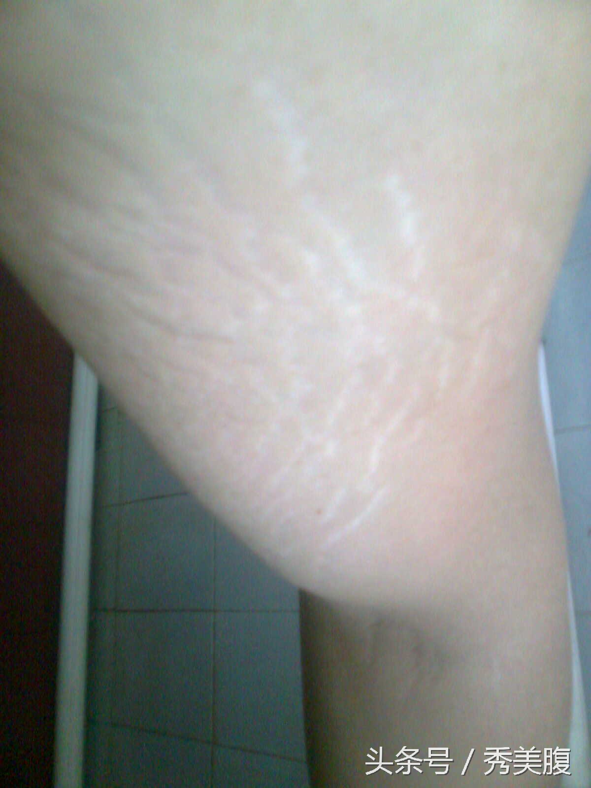 大腿内侧的肥胖纹可以锻炼去除吗,大腿上有肥胖纹怎么解决