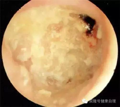 化脓性中耳炎,化脓性中耳炎清理