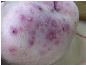 脸上起了好多红色的小痘痘摸着痛,脸上痘痘好了有红色疙瘩不痛不痒