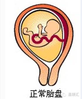 如何观察早期胎盘异常,知道这五点管理就会轻而易举