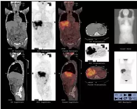 PET-CT检查辐射量有多大,做pet-ct与普通ct哪个辐射大