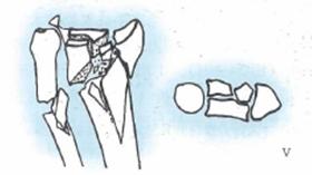 桡骨远端骨折传统石膏打法,成人桡骨远端骨折诊疗指南2023版