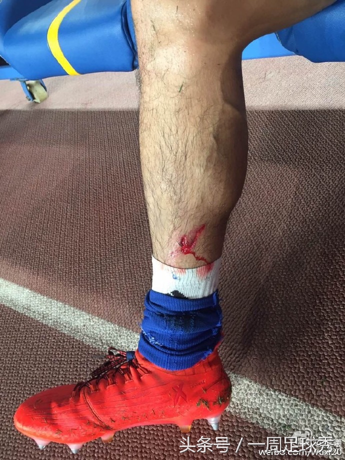 江苏苏宁铁腰微博贴上伤口照片，鞋钉痕明显！心塞！