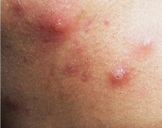 疮疡诊断要点是什么,1期压疮的护理要点