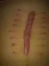 横切剖宫产后的疤痕,剖腹产横切和竖切二年愈合照片