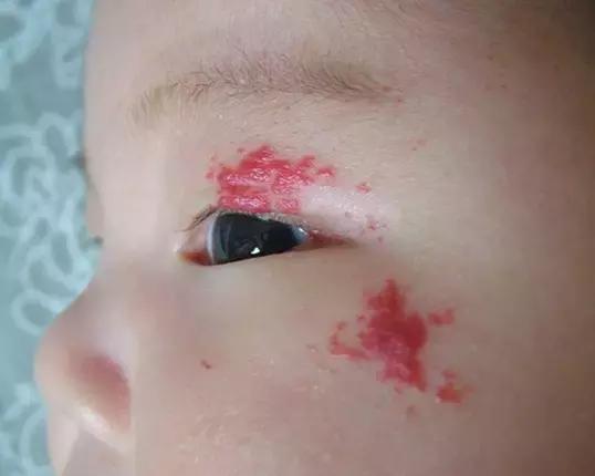 白色胎记的图片,胎记知多少基础篇