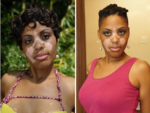 孕妇的白癜风怎么办,孕妇有白癜风会遗传给胎儿吗