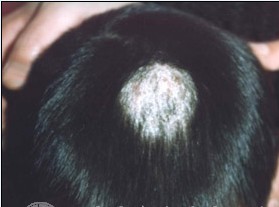 头皮癣多是什么原因引起的,糖尿病能不能引起头皮癣