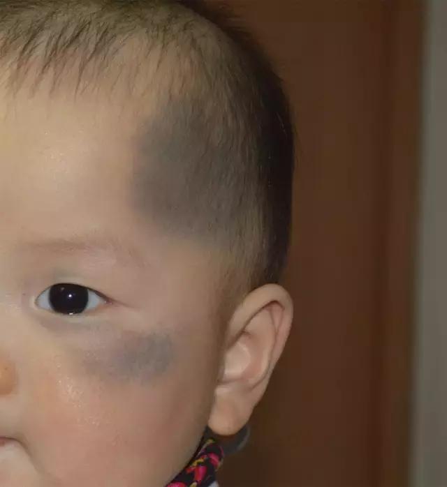 白色胎记的图片,胎记知多少基础篇