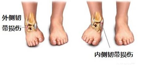 脚扭了肿了鼓包了怎么处理,脚刚扭了应该可以先怎么处理