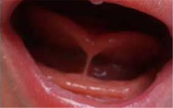 宝宝w型舌需要处理吗,宝宝w型舌头体质怎么样