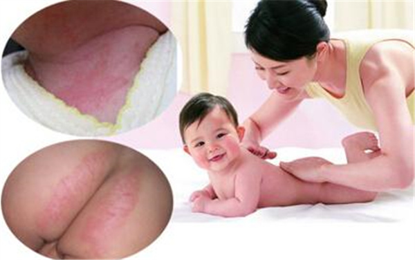 宝宝的尿布上有湿疹怎么办,宝宝得尿布疹怎么根治