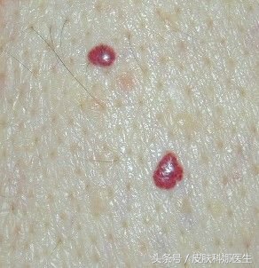 皮肤上有一细小点红痣是代表什么,脸上长的红痣能用药点吗