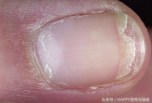 指甲变脆、开裂？你的身体里一定是缺少了这种元素！