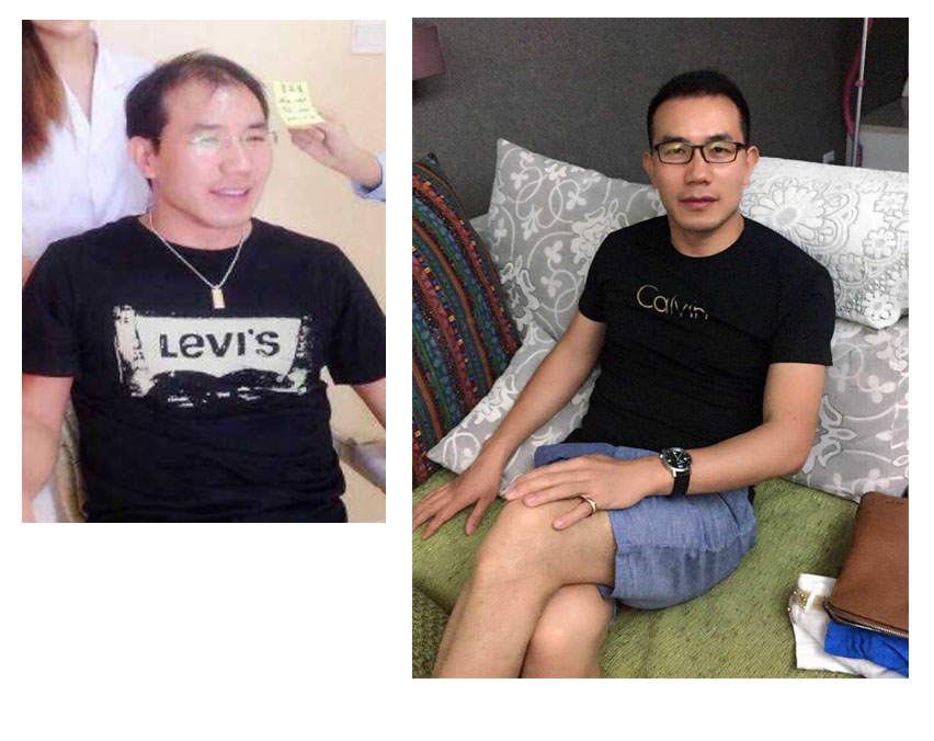 发现老公秃顶怎么办,老公结完婚以后开始秃头怎么办