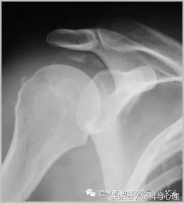 软组织钙化与骨化,软组织钙化和骨质增生