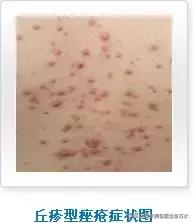 痘痘十大真相,痘痘大全图解