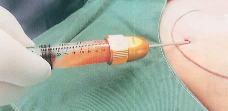 橘皮组织的最佳治疗方法,橘皮症与橘皮纹