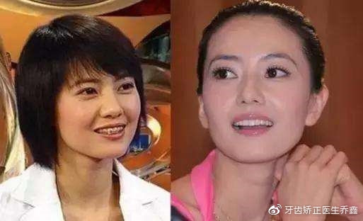 矫正牙齿戴牙套好还是隐形牙套好,牙齿矫正用隐形牙套还是传统牙套