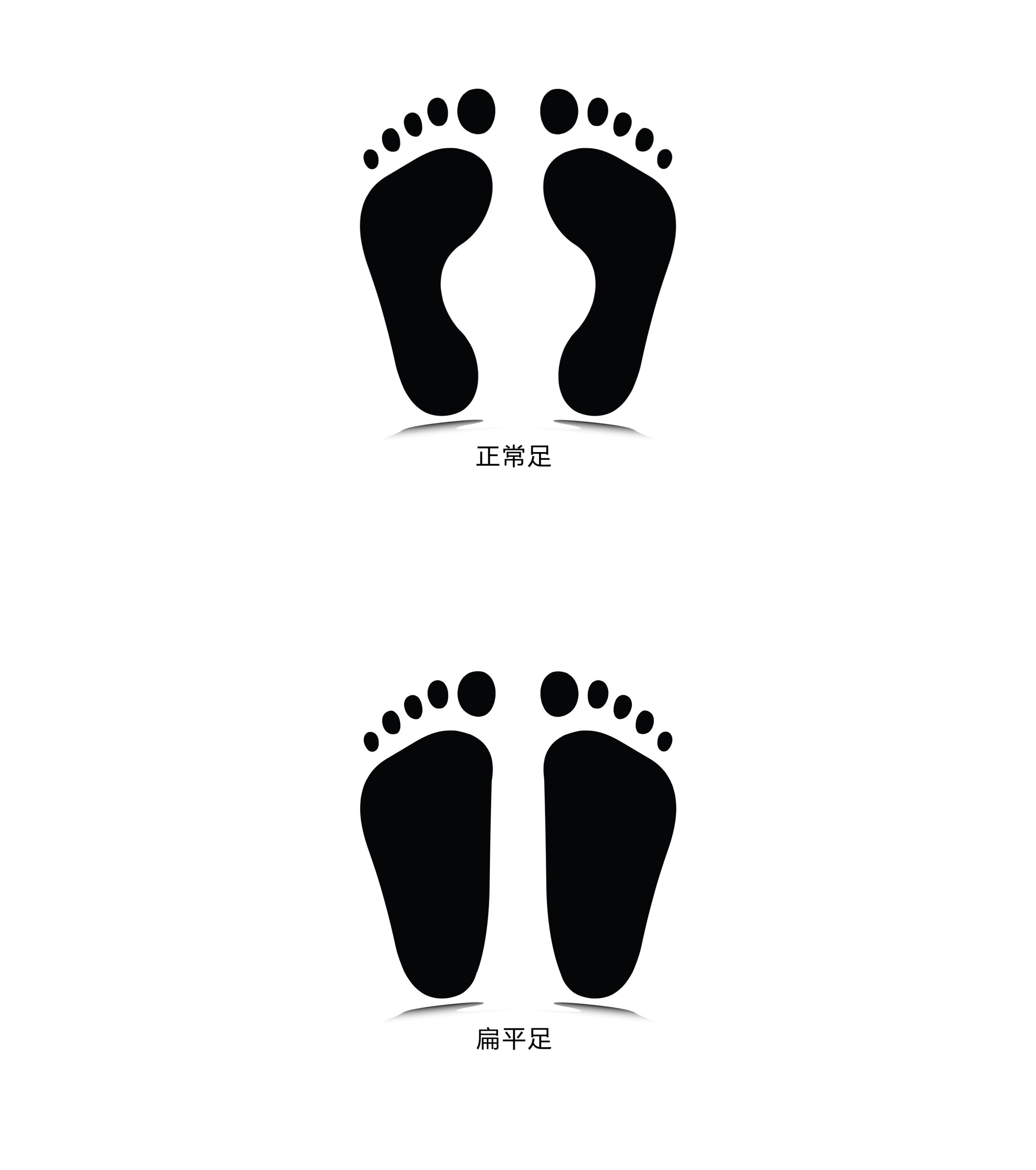 扁平足的危害竟然这么大,扁平足危害的介绍