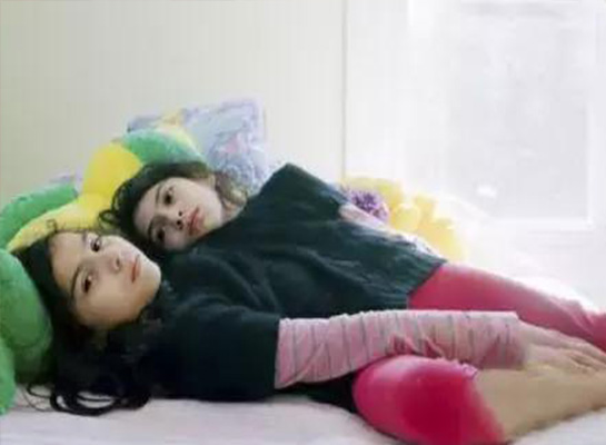 连体人一方去世,假如说有一个连体人去世了